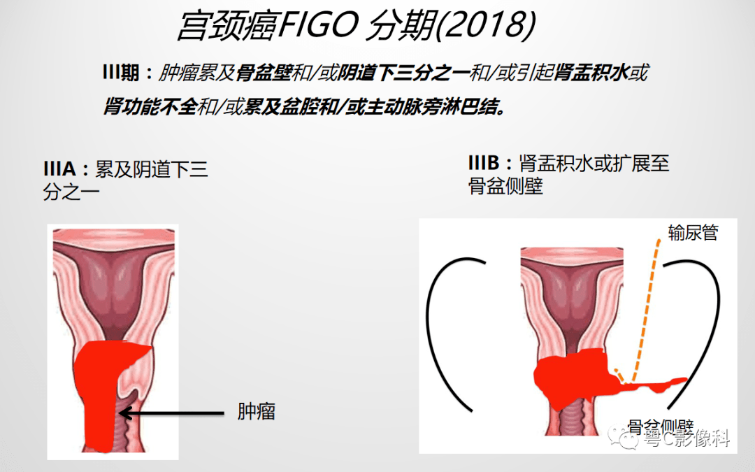 壓瘡的分期及臨床表現(xiàn)最新版