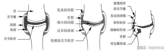 關節軟骨再生最新消息